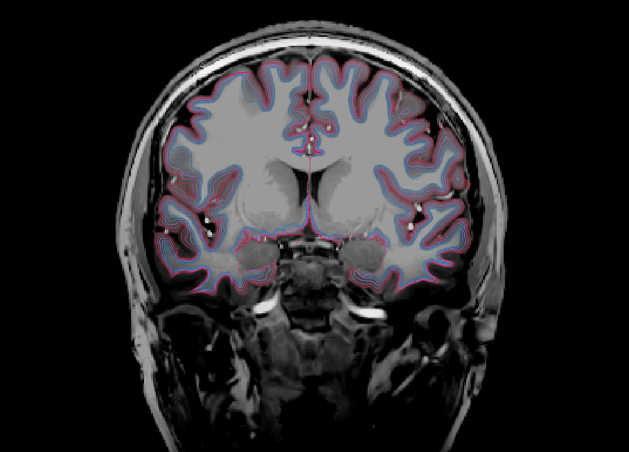 Coronal (WM + Depths + Pial)